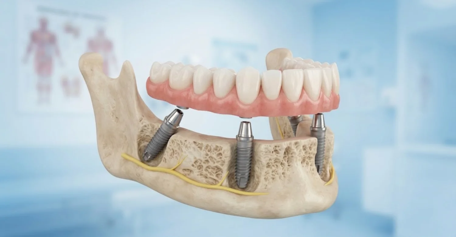 Posterior Mandibular Bone Loss with Fixed Implant Prostheses 2